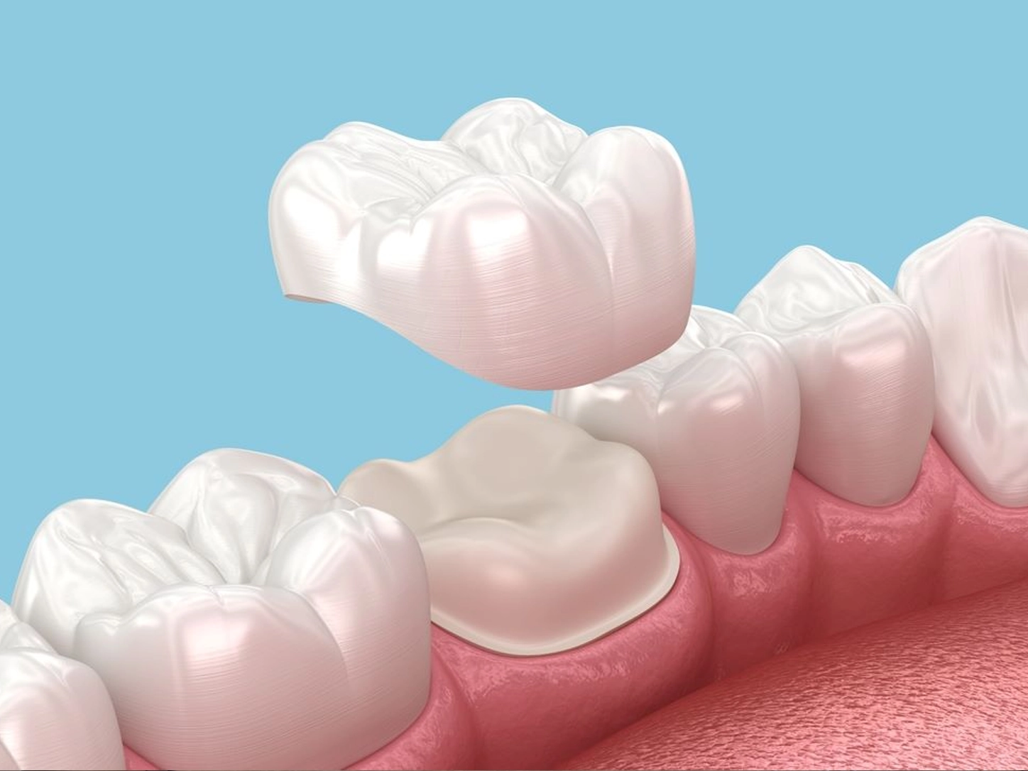 Dental crown being placed by dentist