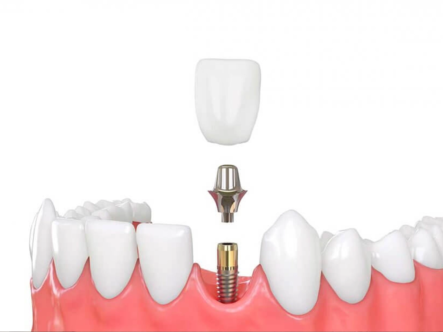 Dental implant abutment and crown