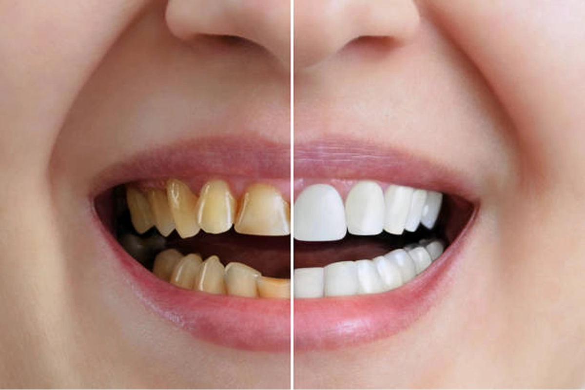 Cosmetic Dentistry at Gateway Dental