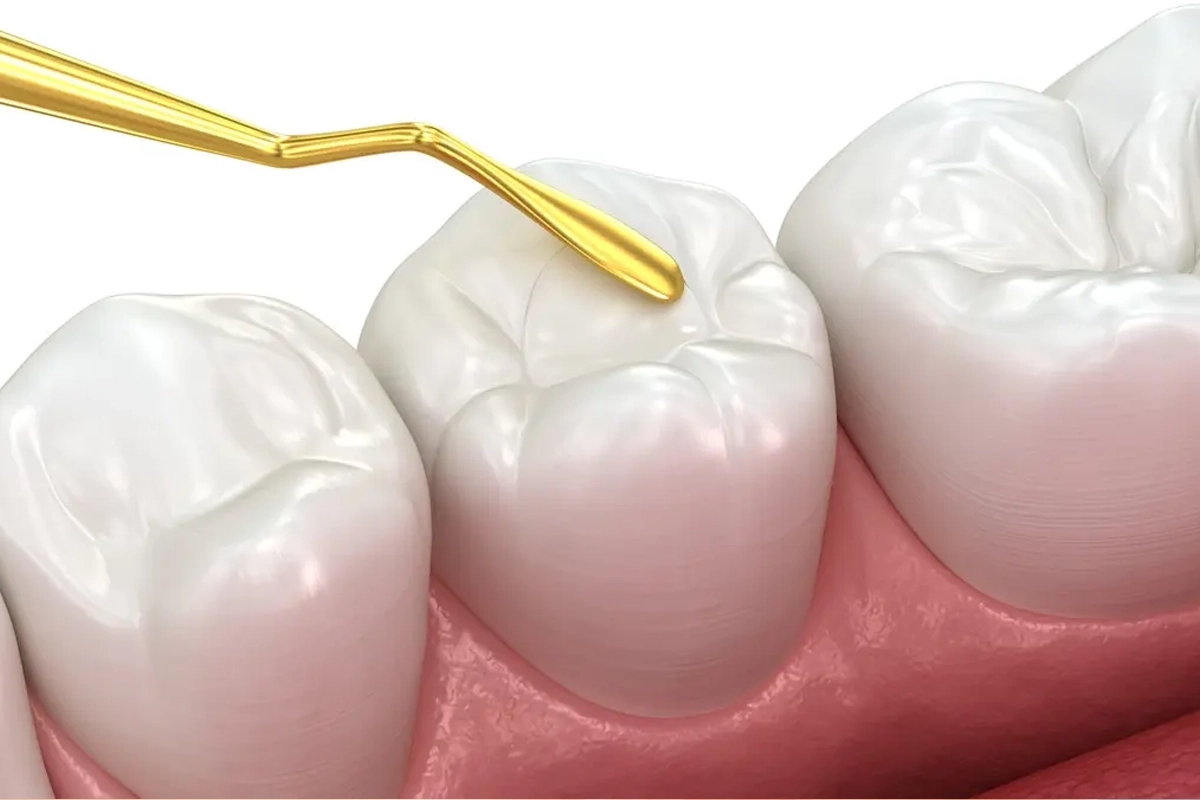 Dental Sealants at Gateway Dental