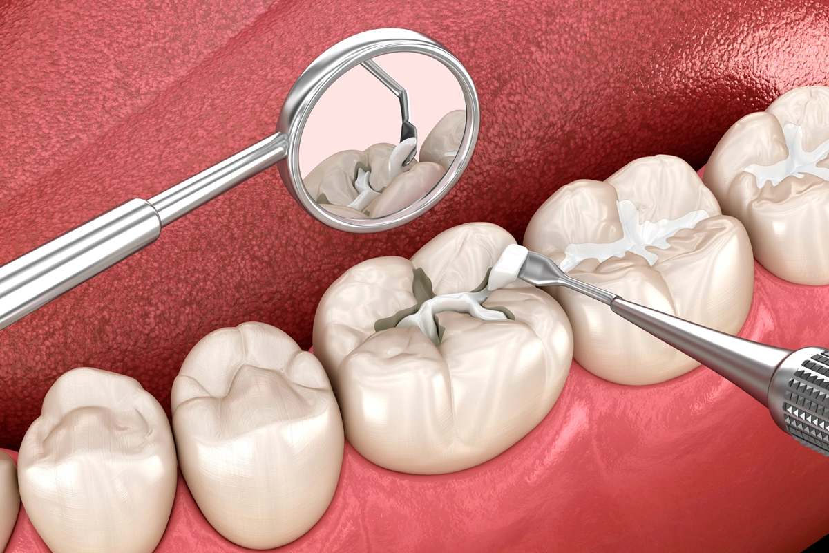 Dental Sealants at Gateway Dental