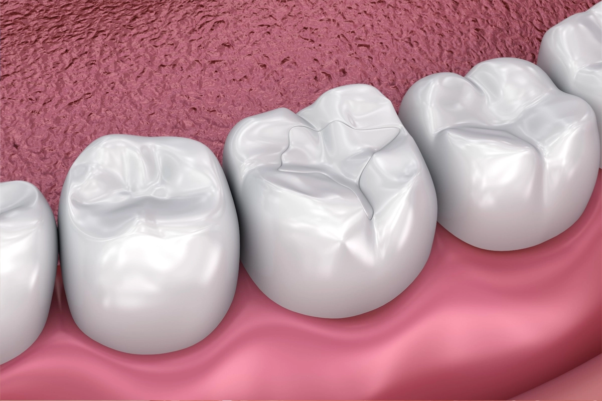 Dental Sealants at Gateway Dental