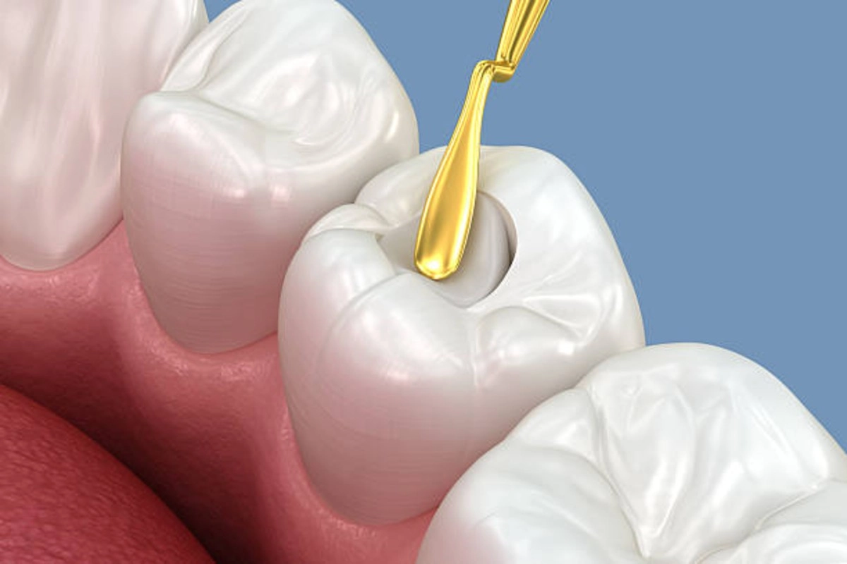 Dental Sealants at Gateway Dental