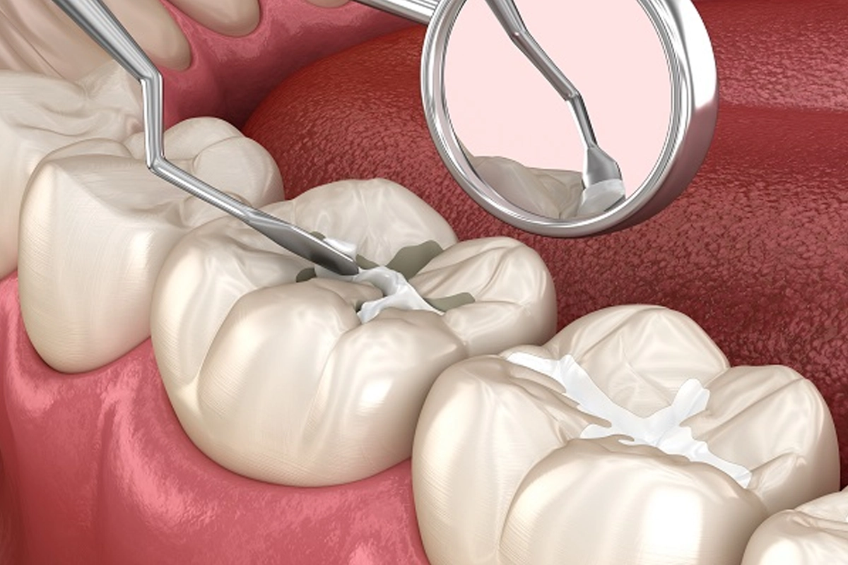 Dental Sealants
