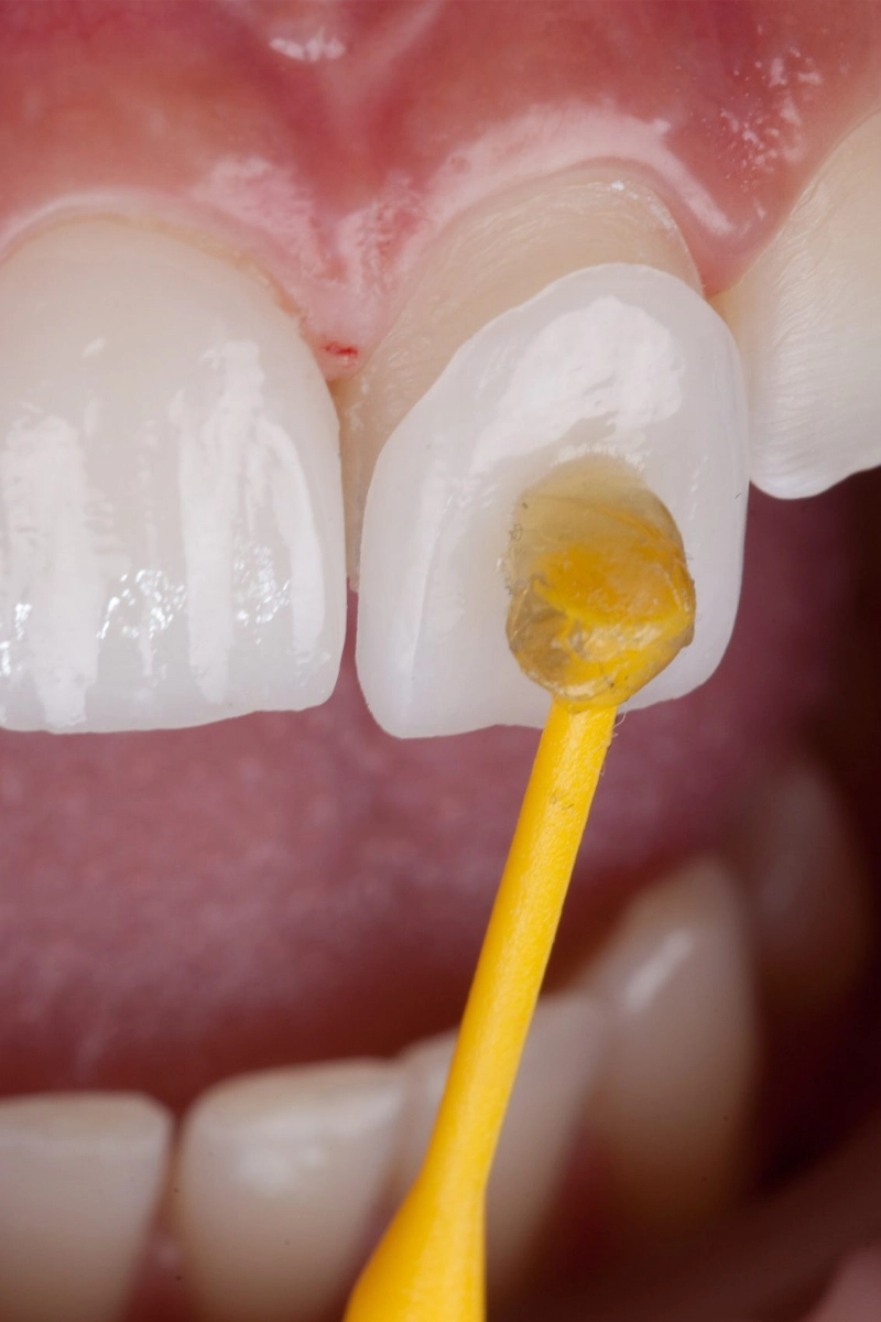 Dental Veneers at Gateway Dental