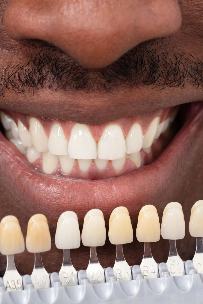 Dental Veneers at Gateway Dental