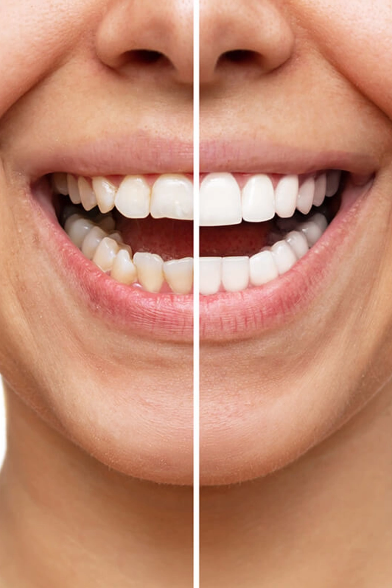 Dental Veneers at Gateway Dental