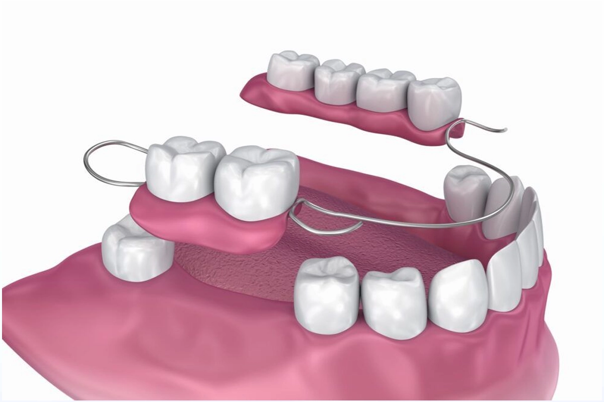 Dentures and Partials at Gateway Dental