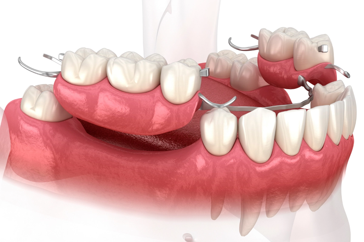 Dentures and Partials at Gateway Dental