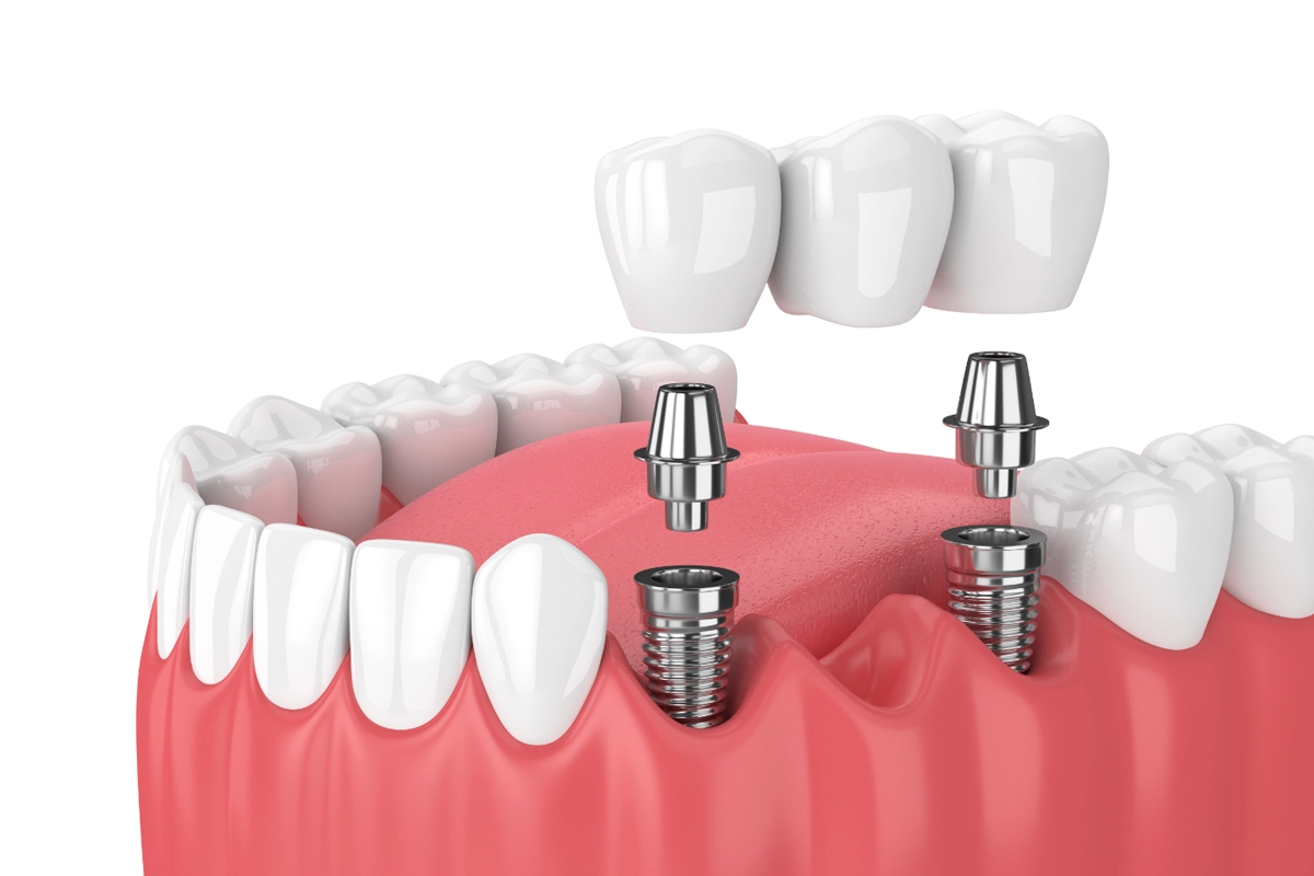 Implant Dentistry at Gateway Dental