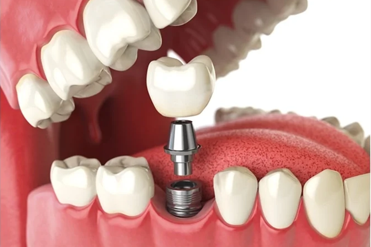 Implant Dentistry at Gateway Dental