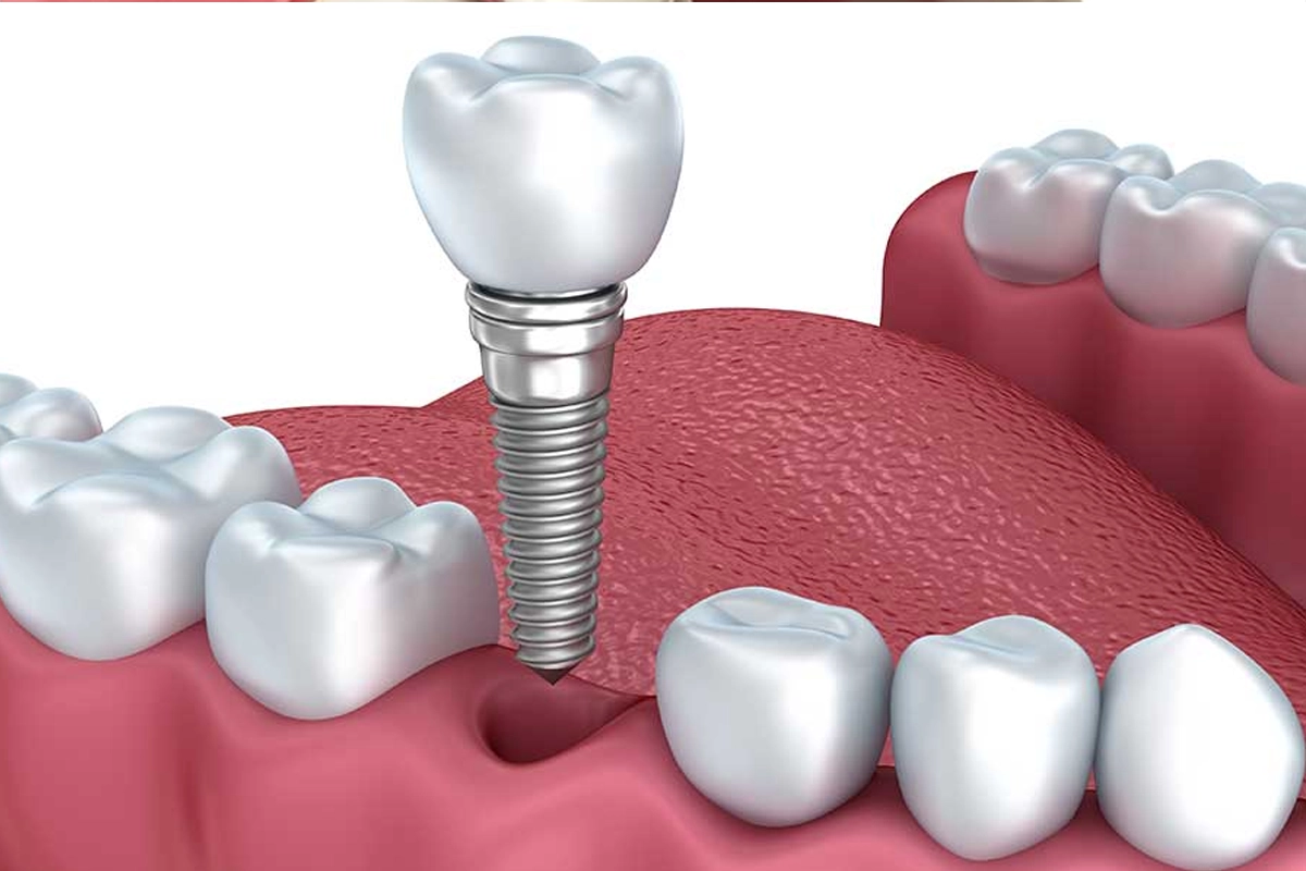 Implant Dentistry at Gateway Dental