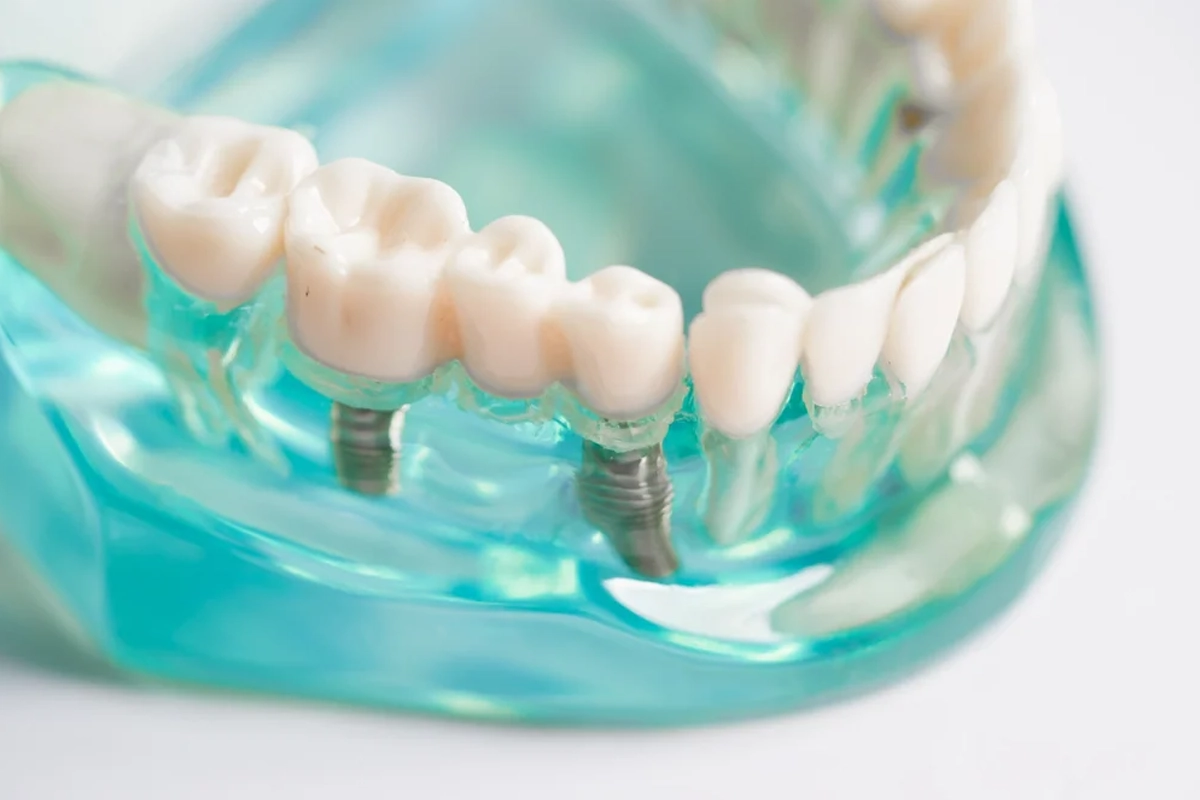 Implant Dentistry at Gateway Dental