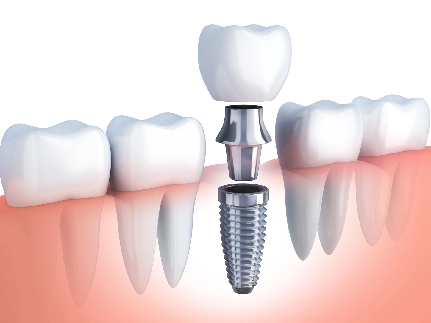 Implant Dentistry