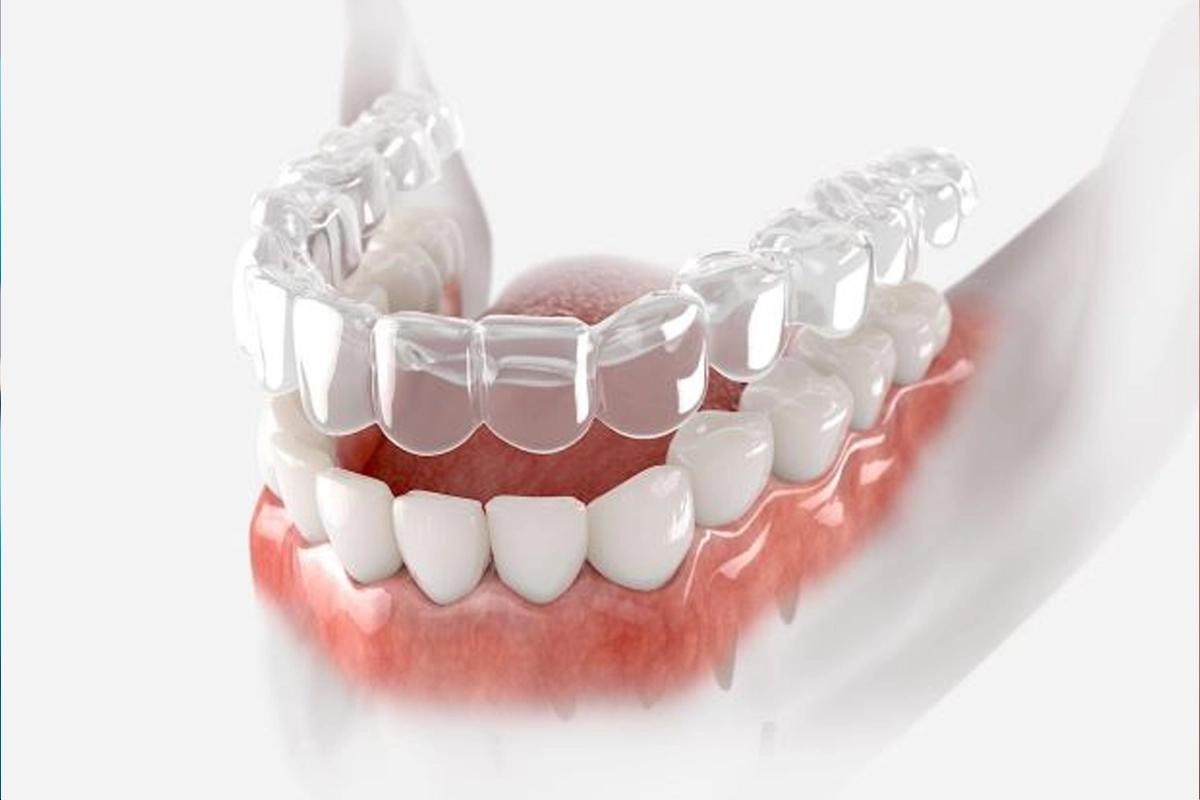 Invisalign & ClearCorrect at Gateway Dental