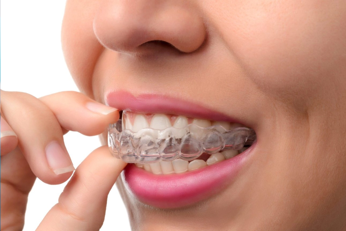 Invisalign & ClearCorrect at Gateway Dental