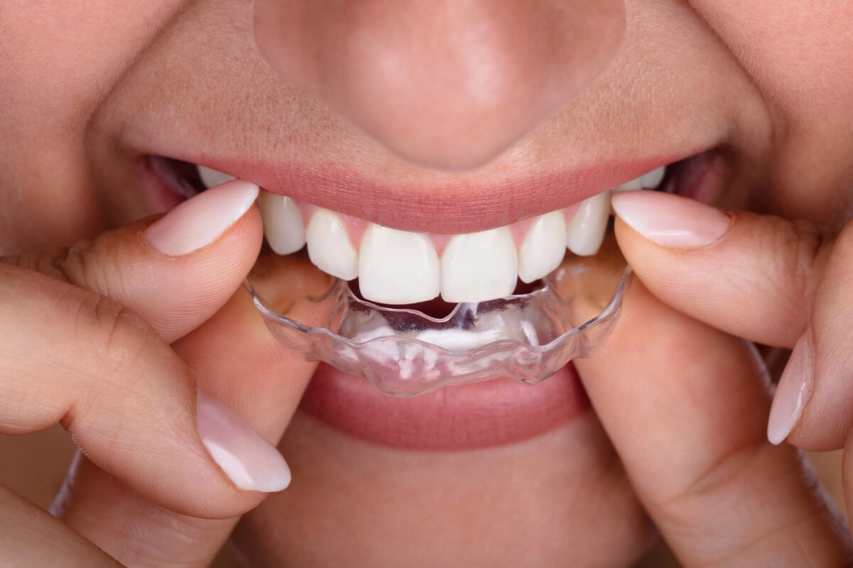 Invisalign & ClearCorrect at Gateway Dental