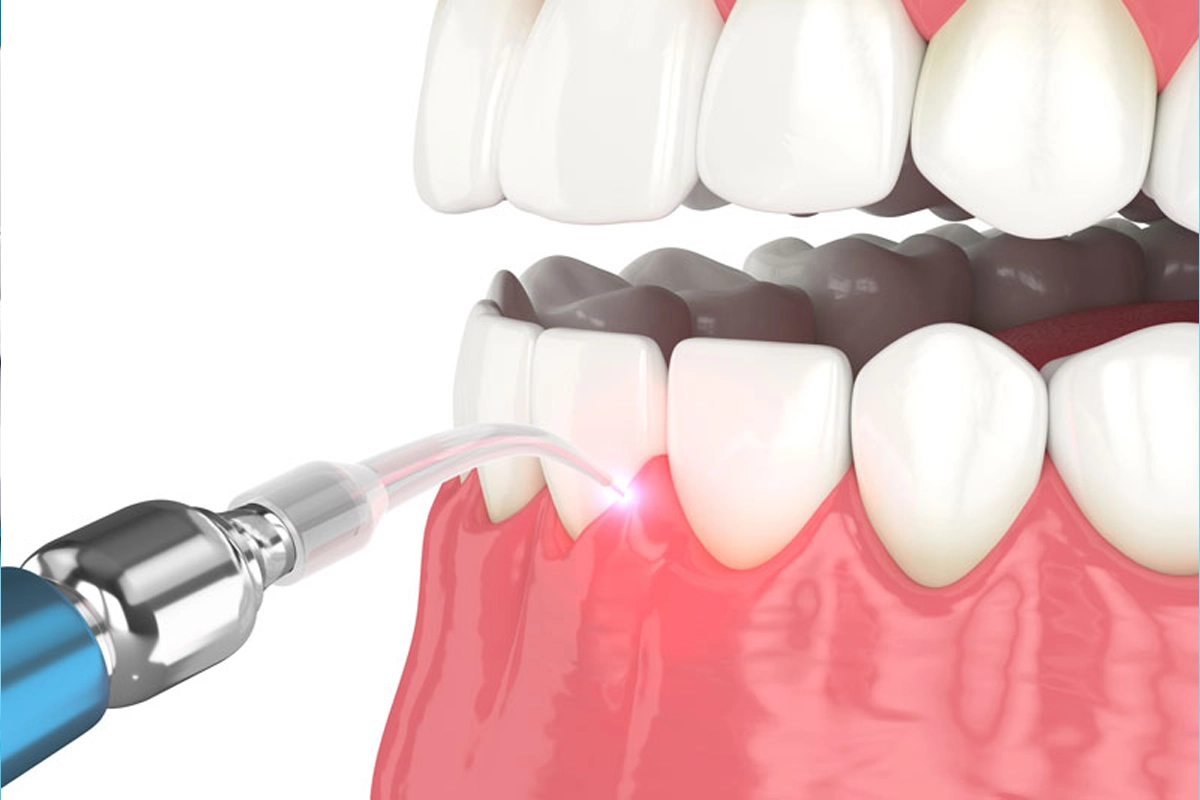 Laser Gum Disease Treatment at Gateway Dental
