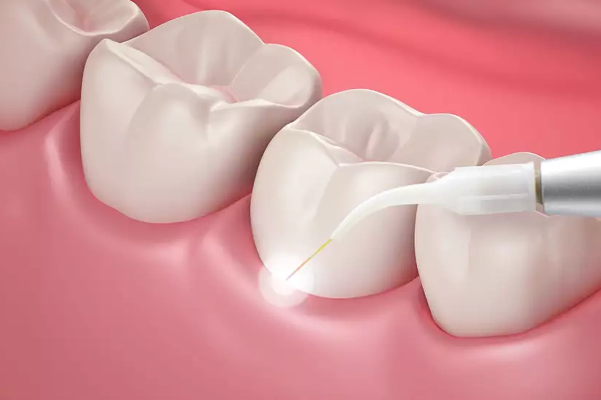 Laser Gum Disease Treatment at Gateway Dental