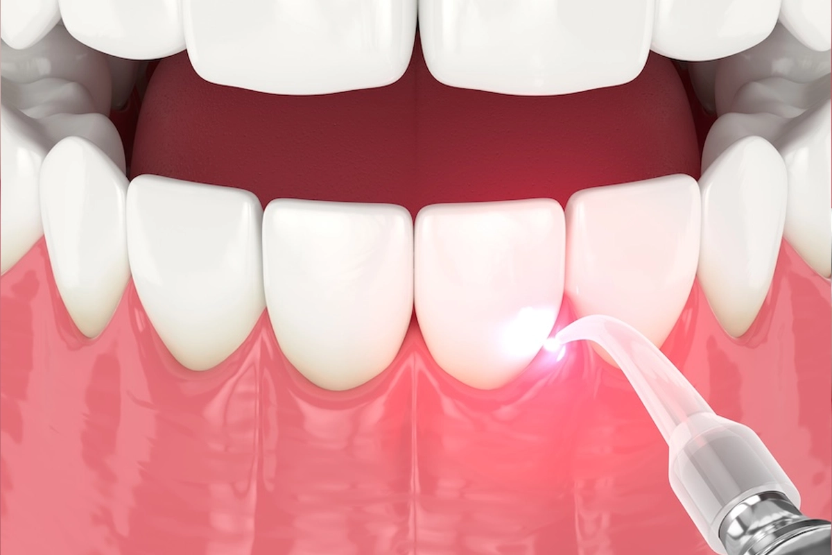 Laser Gum Disease Treatment at Gateway Dental