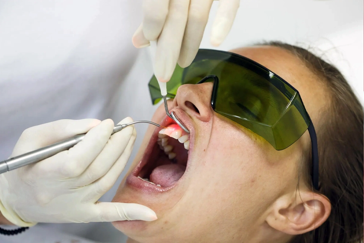 Laser Gum Disease Treatment at Gateway Dental