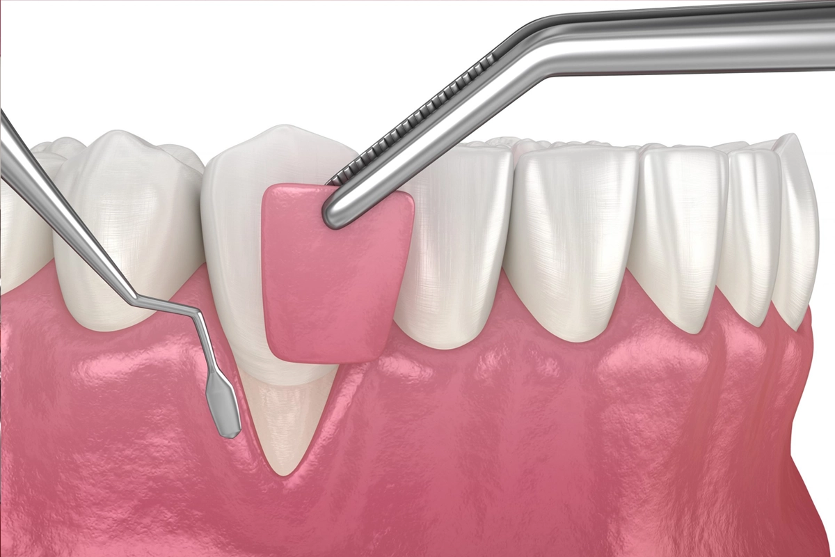 Laser Gum Disease Treatment at Gateway Dental