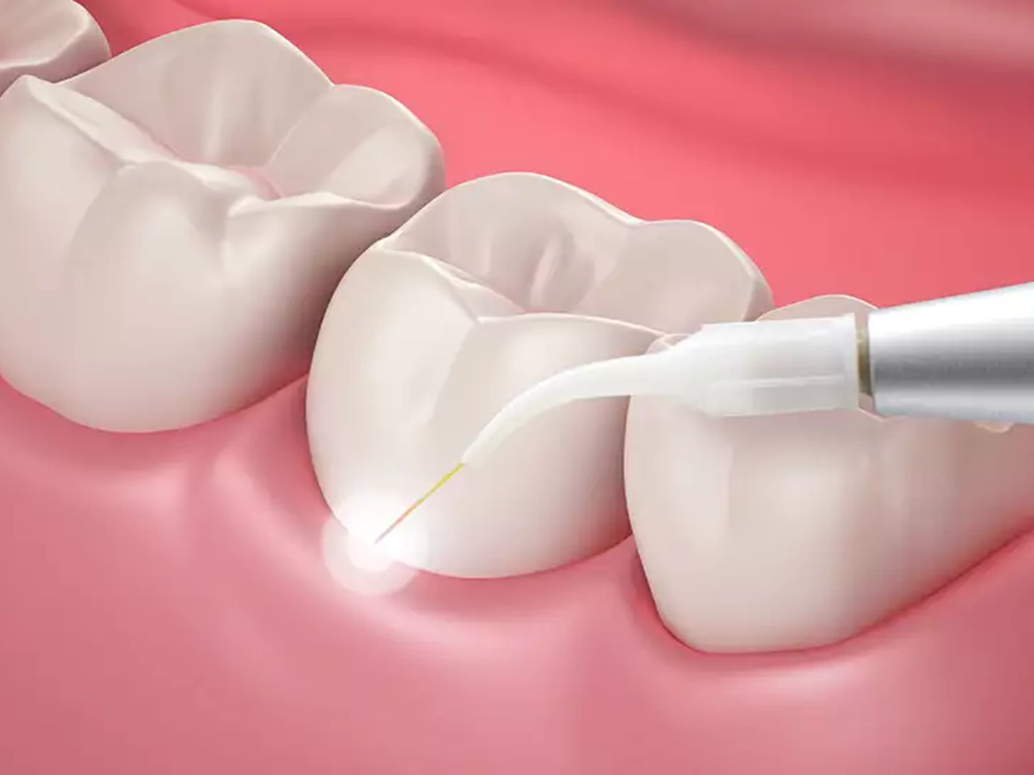 Laser Gum Disease Treatment