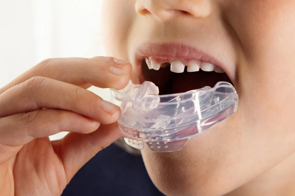 Mouth Guards at Gateway Dental