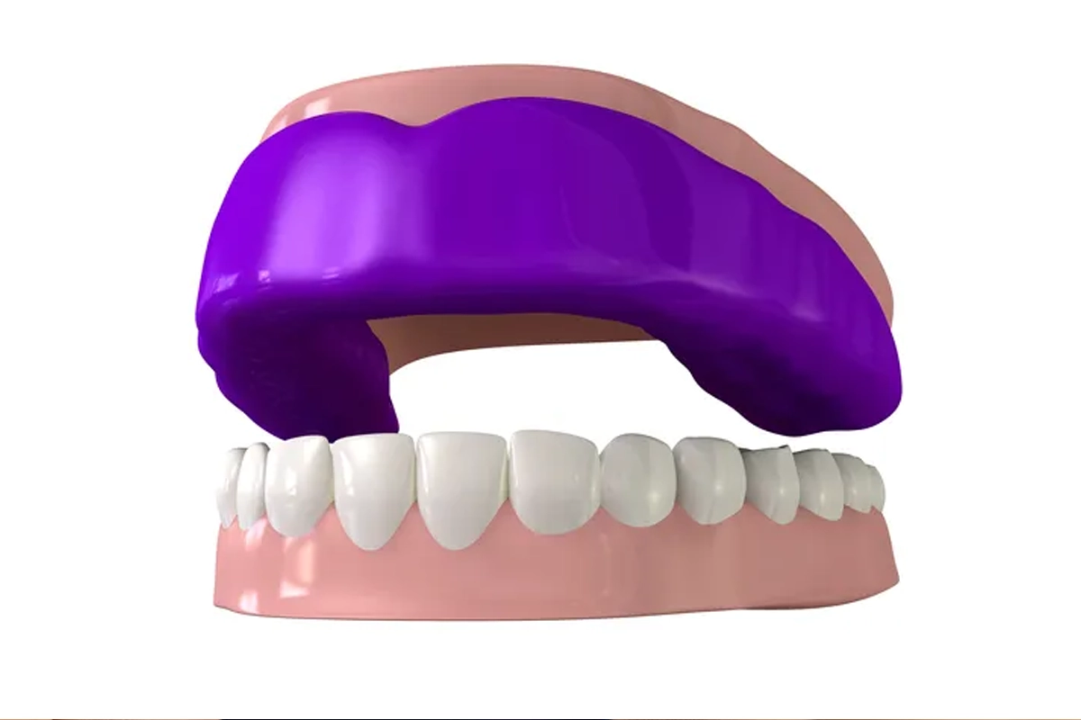 Mouth Guards at Gateway Dental