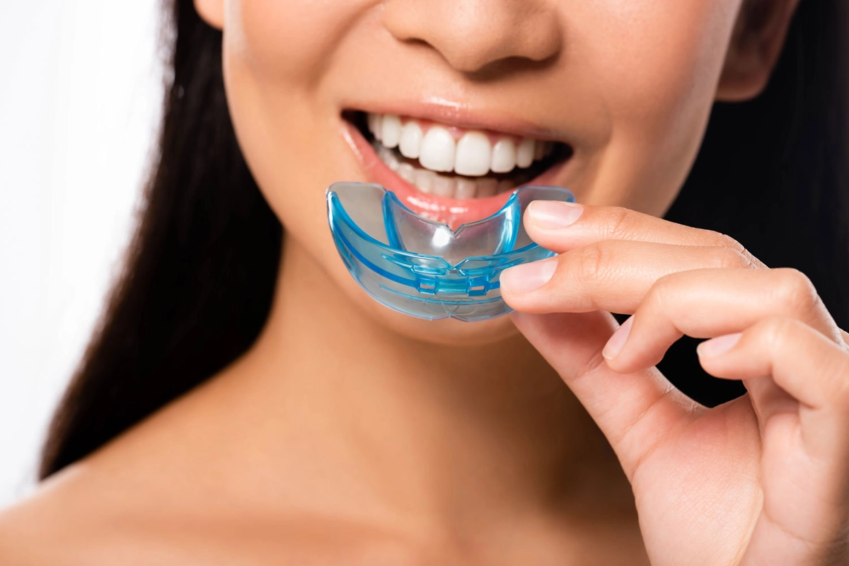 Mouth Guards at Gateway Dental