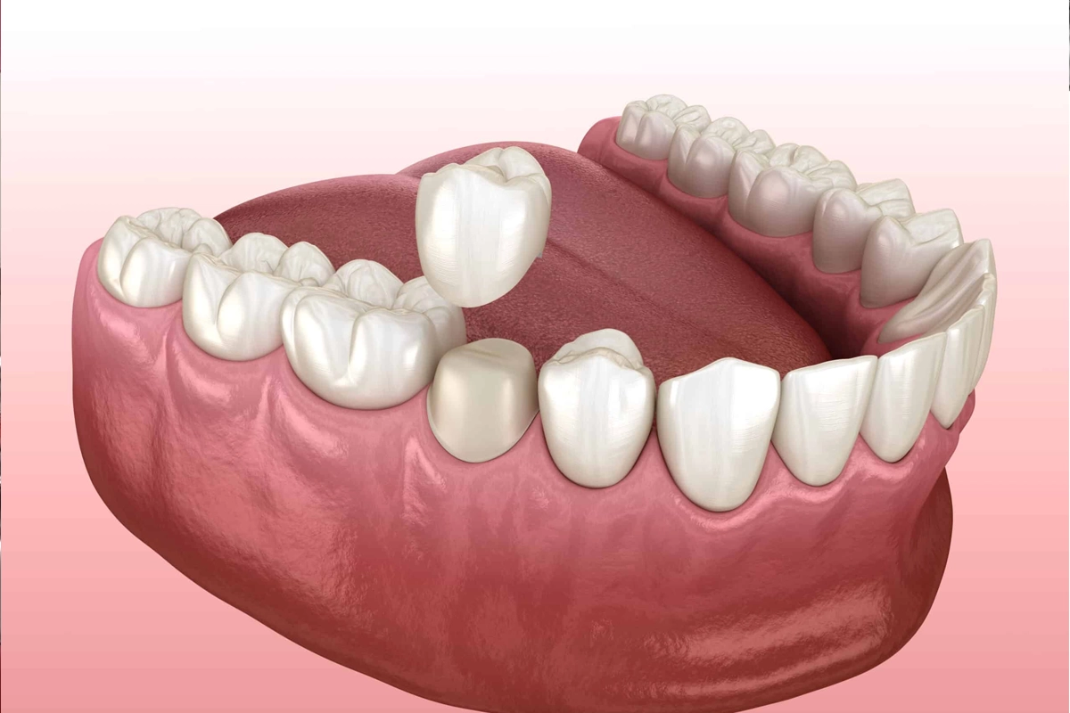 Restorative Dentistry at Gateway Dental