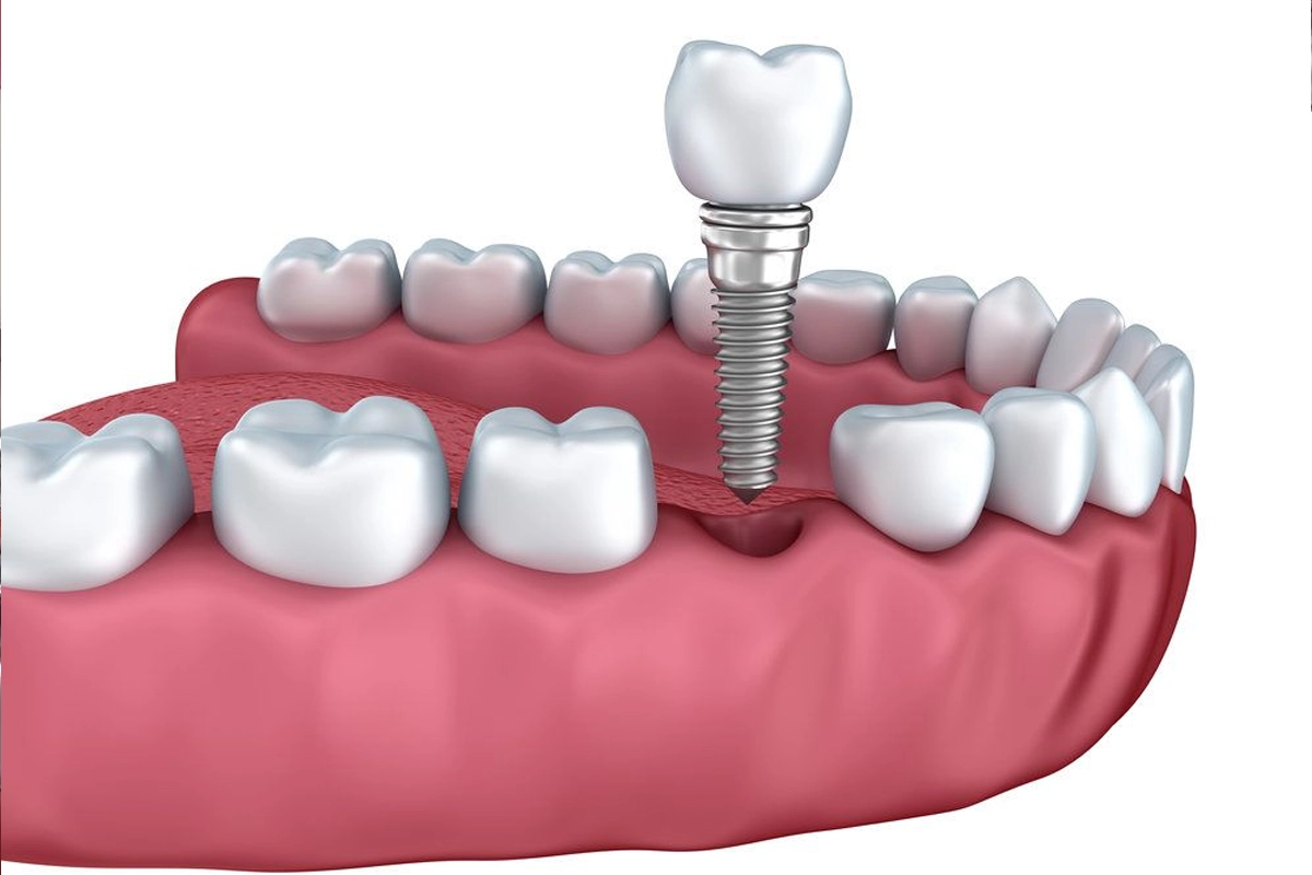 Restorative Dentistry at Gateway Dental