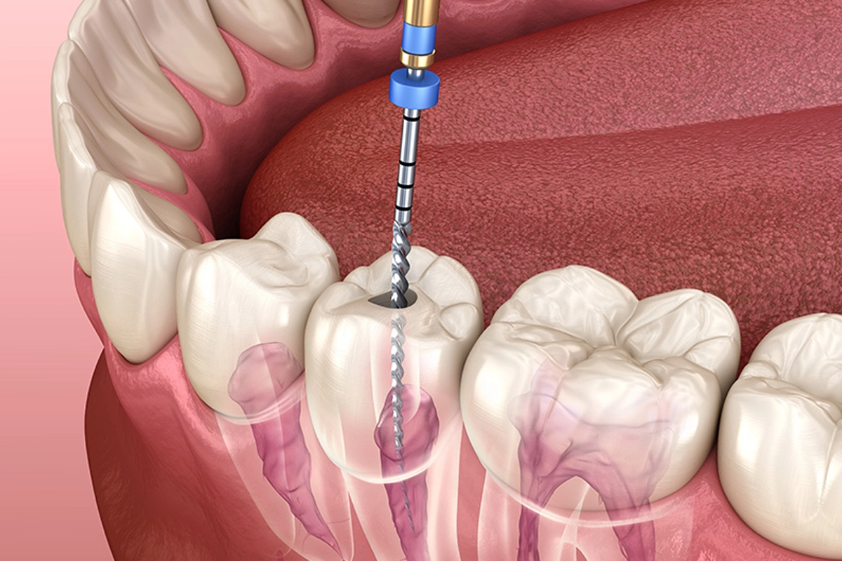 Root Canal Treatment at Gateway Dental