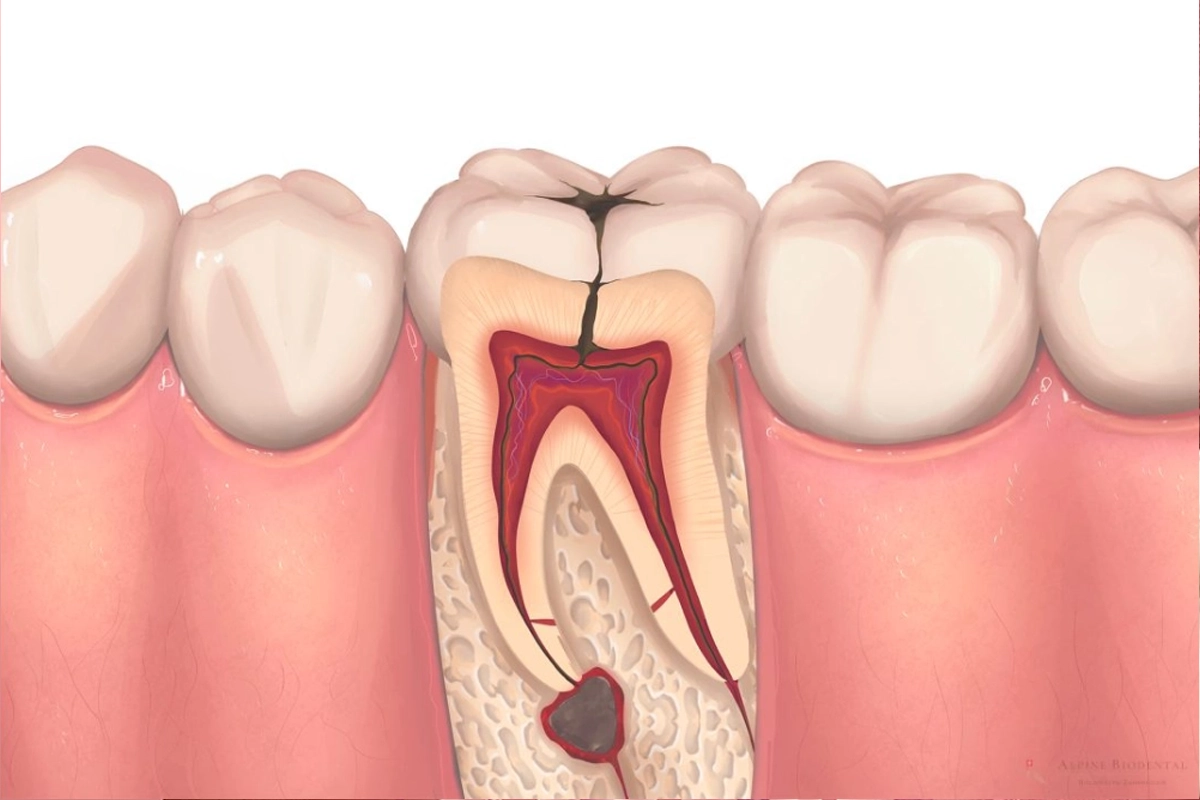Root Canal Treatment at Gateway Dental