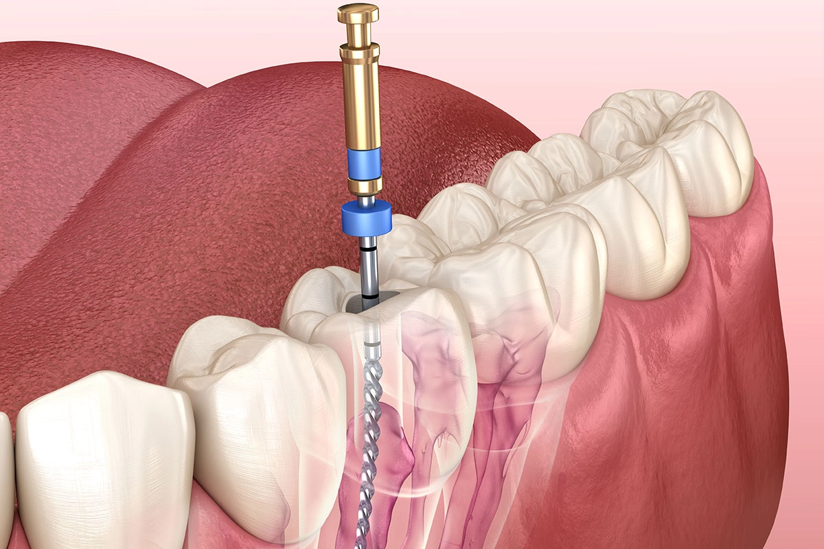 Root Canal Treatment at Gateway Dental