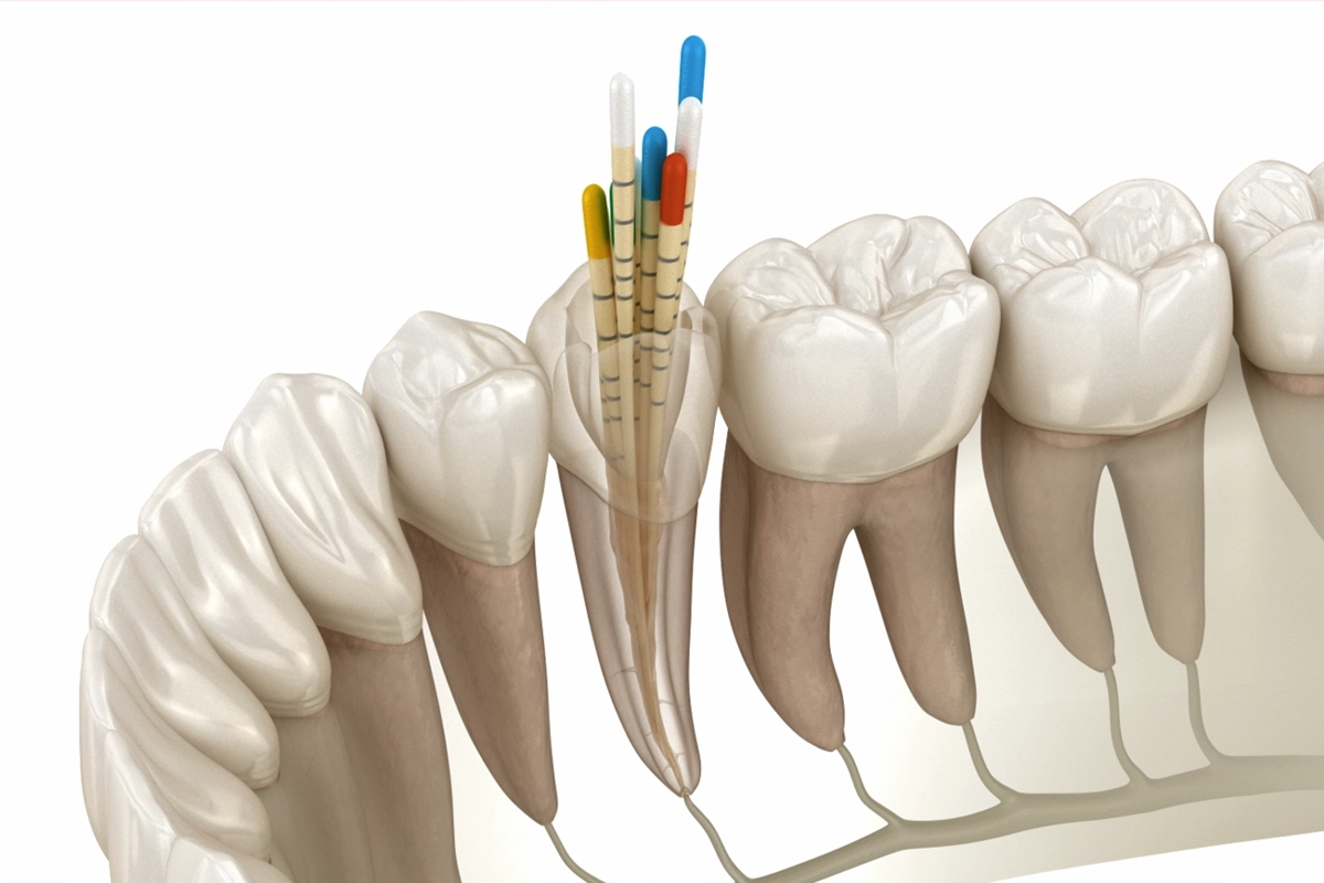 Root Canal Treatment at Gateway Dental