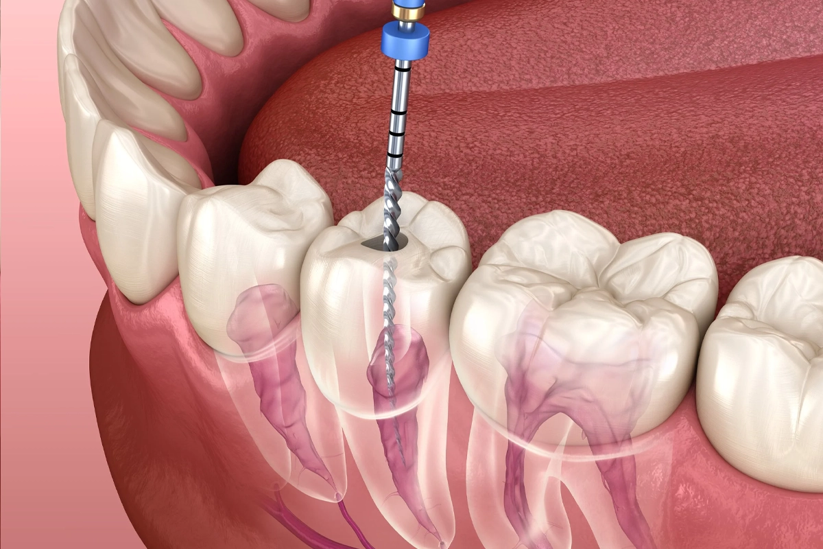 Root Canal Treatment