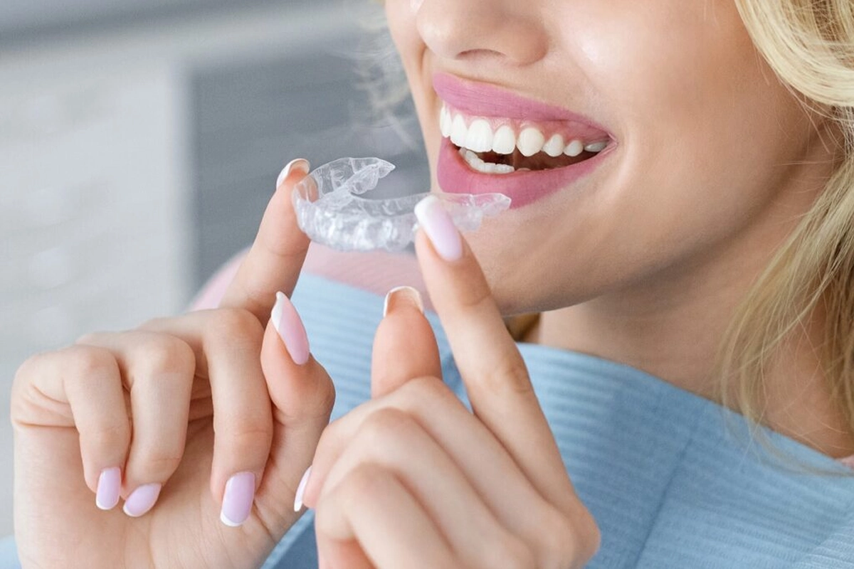 Clear Aligners