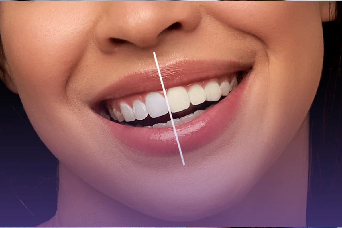 Teeth Whitening at Gateway Dental