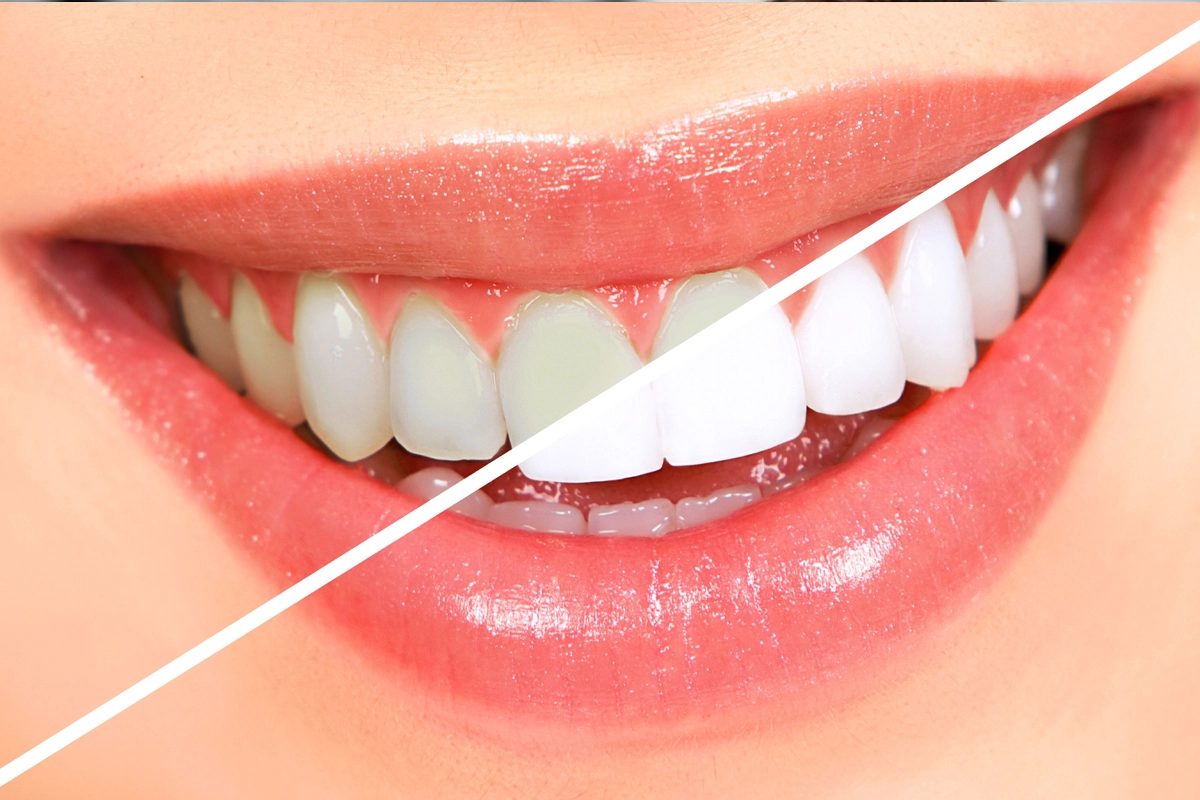 Teeth Whitening at Gateway Dental