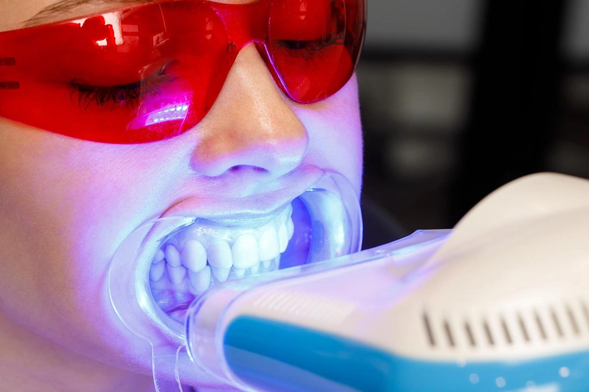 Teeth Whitening at Gateway Dental