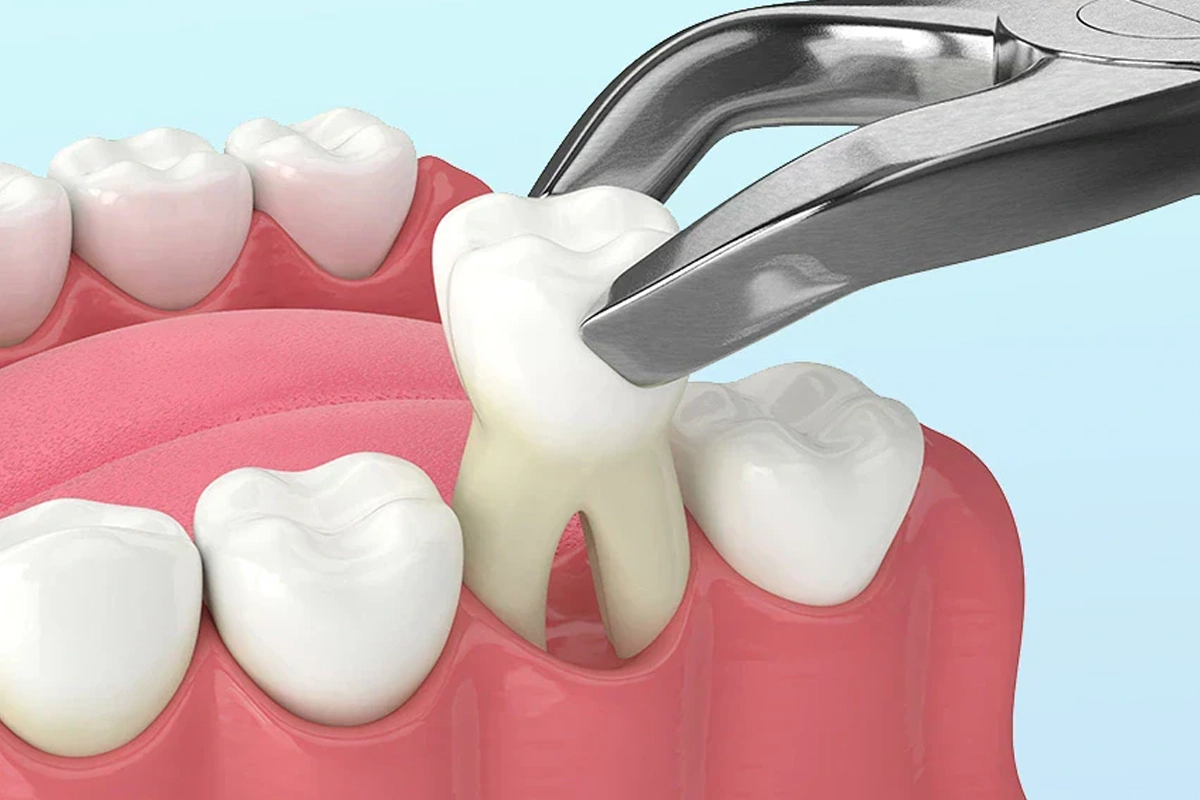 Tooth Extractions at Gateway Dental