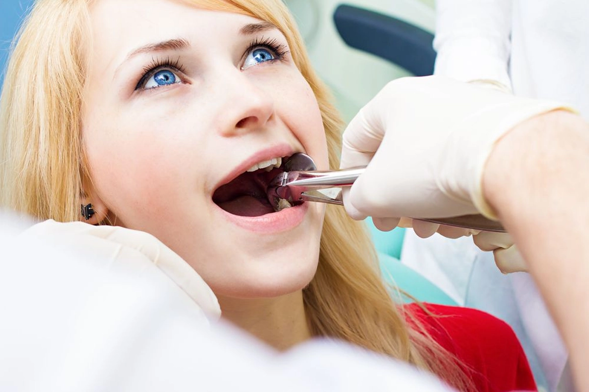 Tooth Extractions at Gateway Dental