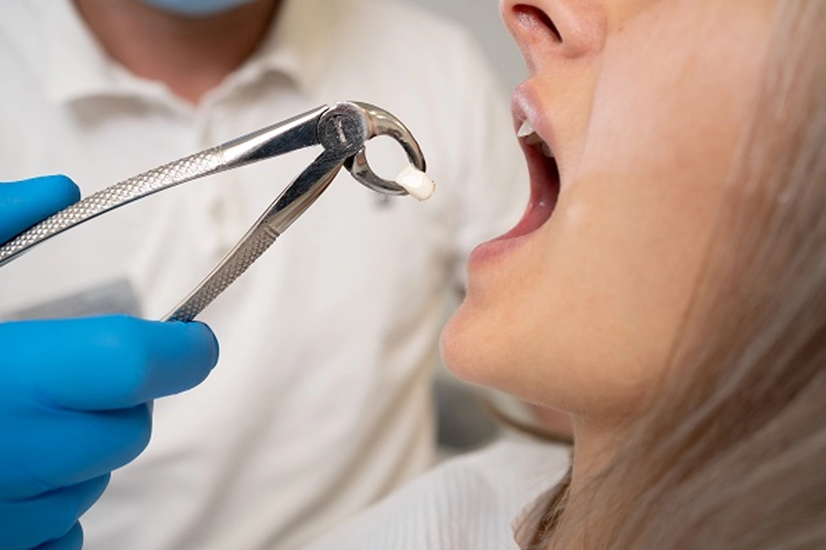 Tooth Extractions at Gateway Dental