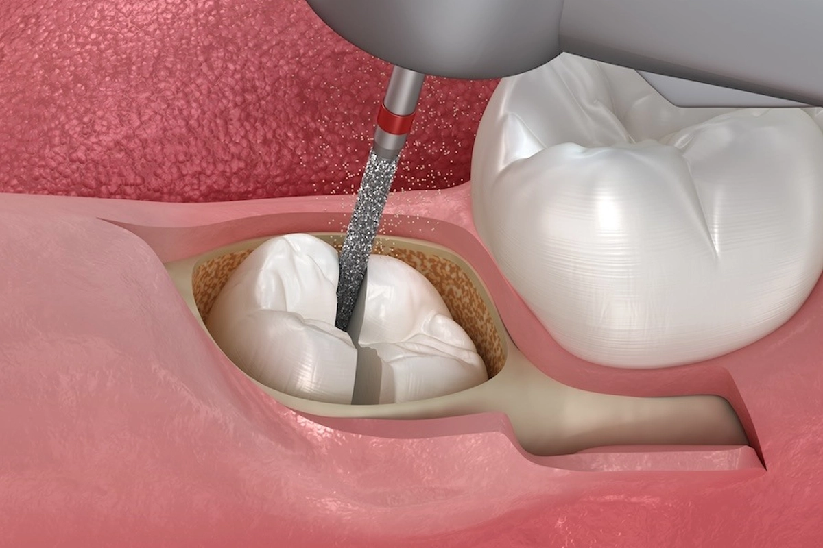 Tooth Extractions at Gateway Dental