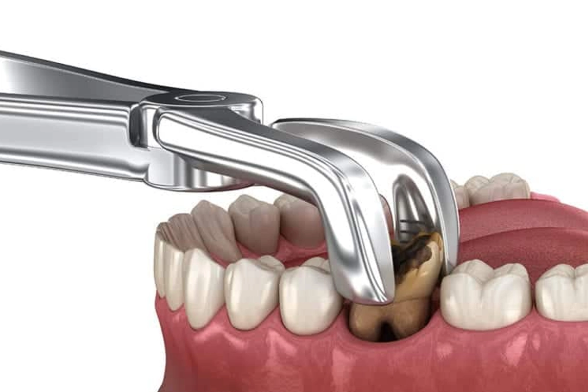 Tooth Extractions at Gateway Dental