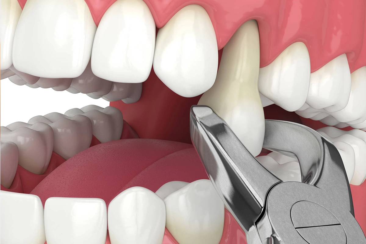 Tooth Extractions